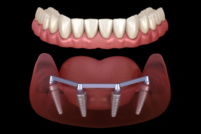dental implants replacement in joplin