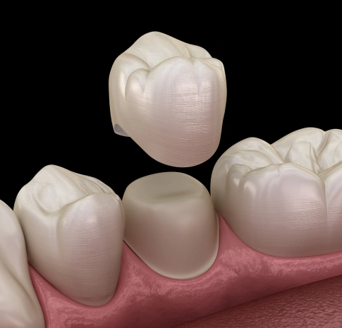 dental implants replacement in joplin