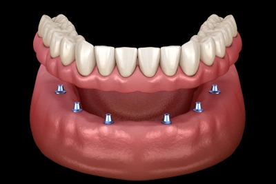 dental implants replacement in joplin