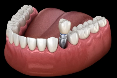 dental implants replacement in joplin