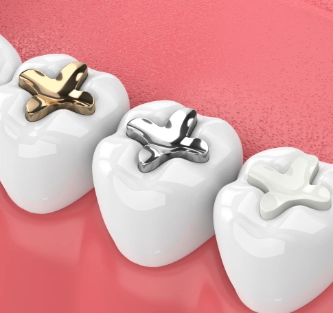 dental implants replacement in joplin