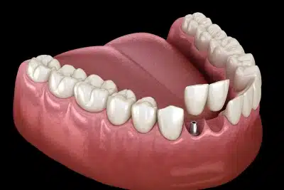 Cantilever dental bridge supported by one adjacent tooth in Carthage