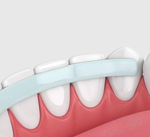 Close-up illustration of dental bonding showing composite resin applied to teeth to improve shape and appearance