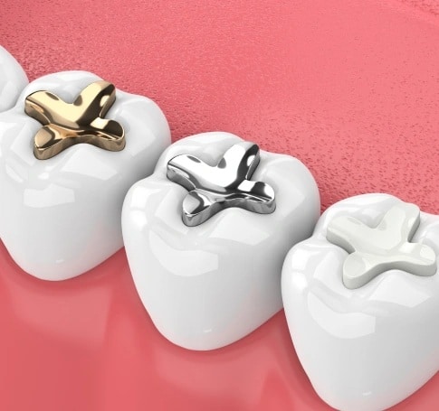 Different types of dental fillings used to restore decayed teeth in Carthage