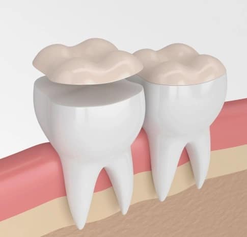 3D illustration of dental onlay covering the chewing surface of a molar to restore damaged tooth