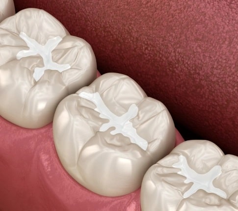 Dental sealants applied on molars to protect teeth from cavities in Carthage