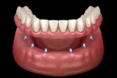 Full mouth dental implants replacing all teeth with permanent solution in Carthage