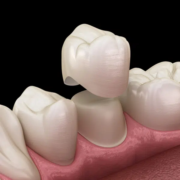 dental implants replacement in joplin