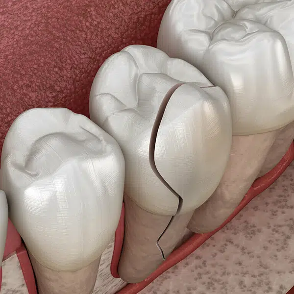 dental implants replacement in joplin