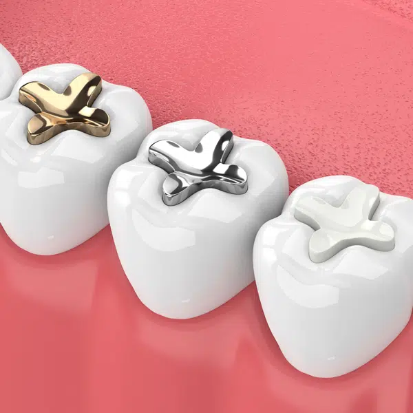 dental implants replacement in joplin