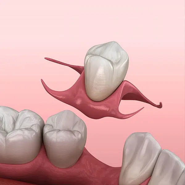 dental implants replacement in joplin