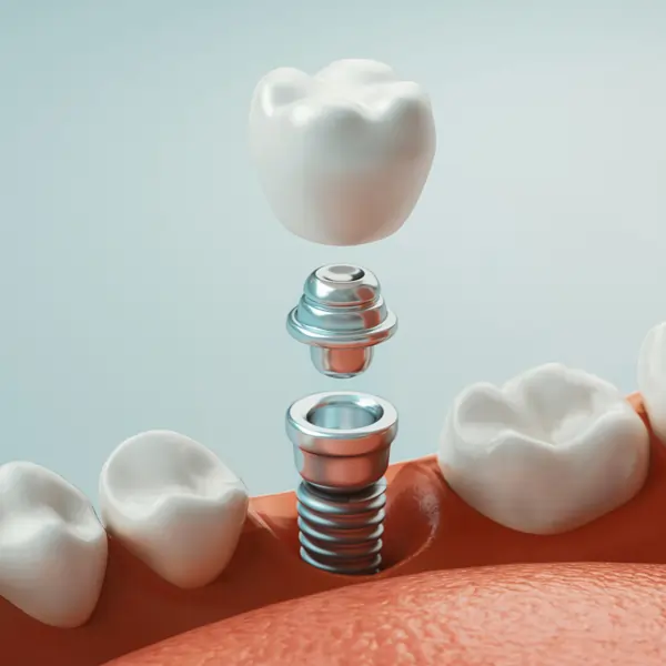 dental implants replacement in joplin