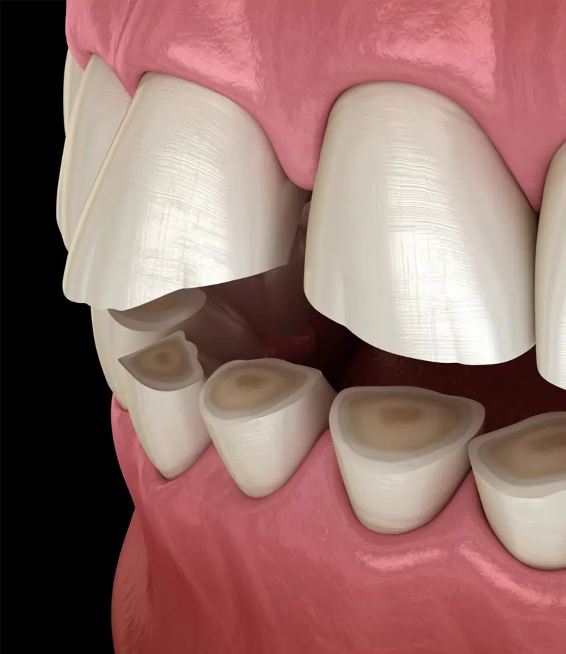 dental implants replacement in joplin