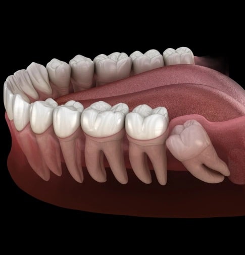 Impacted wisdom tooth causing pain and requiring removal treatment in Carthage