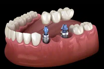 Implant supported bridge replacing multiple missing teeth in Carthage