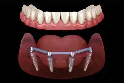 Implant supported dentures All-on-4 restoring full arch teeth in Carthage