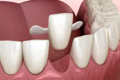 Maryland dental bridge with bonded wings attached to adjacent teeth