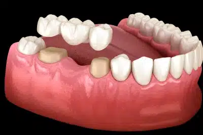 Traditional dental bridge replacing missing tooth supported by adjacent teeth in Carthage